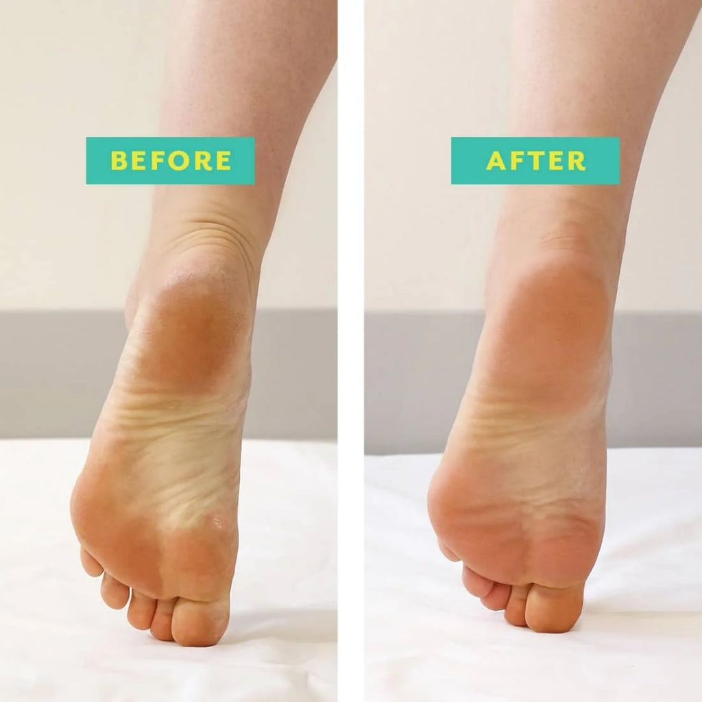 PoshPeel™ PediCure Exfoliating Foot Peel